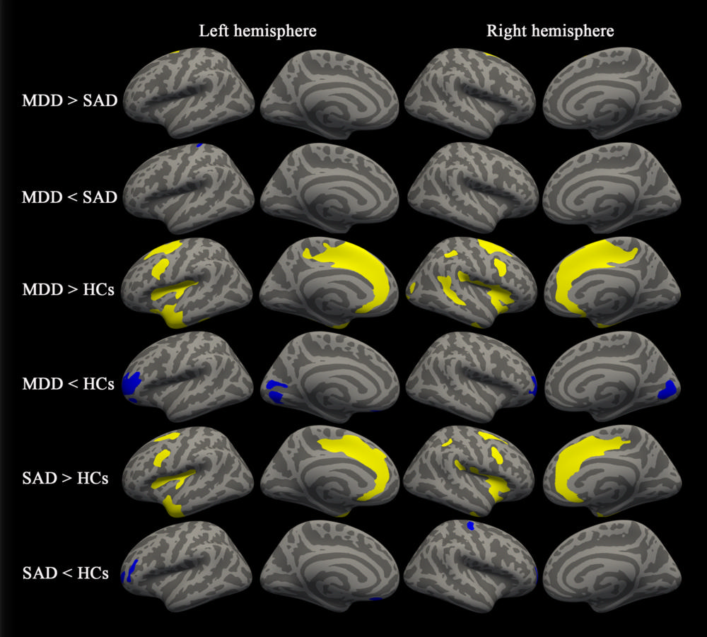 Depressed Vs Normal Brain