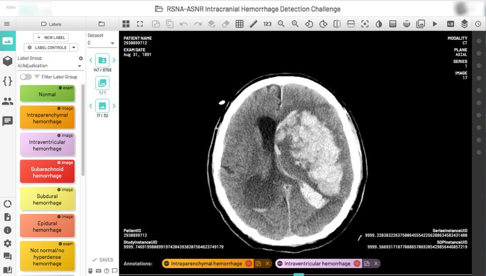 brain hemorrhage scan