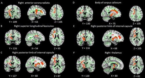 Insomnia Linked to Damage in Brain Communication Networks
