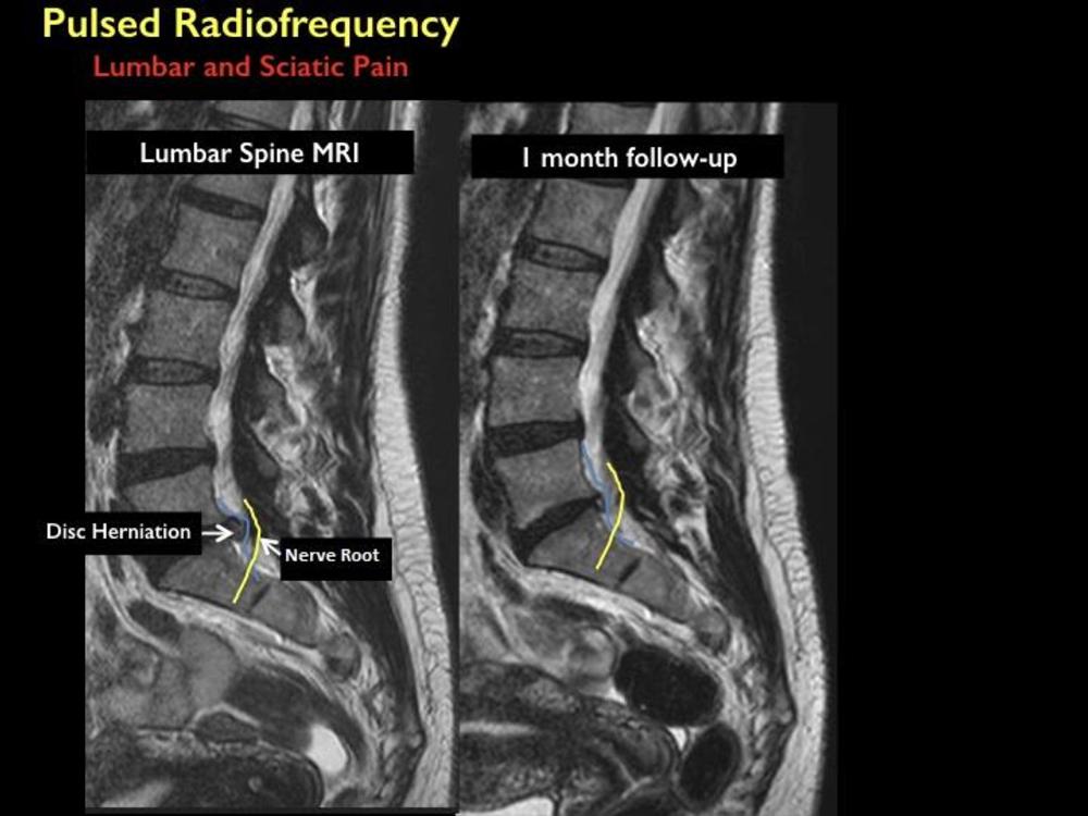 Disc Herniation and Sciatica - Welcome Back Clinic - MRI and Pain  Management Centre