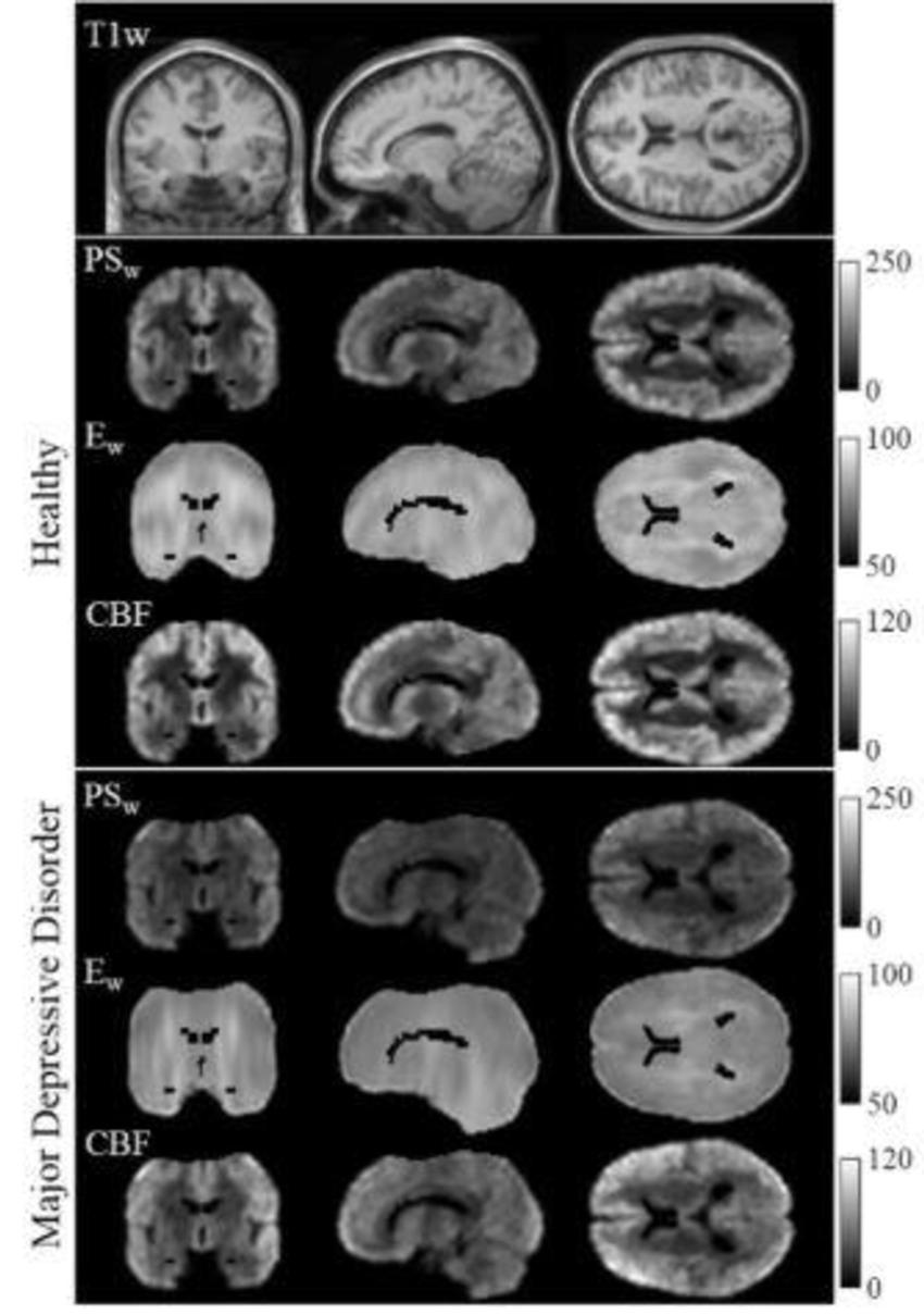 brain scan depression