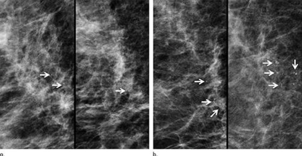 Как выглядят кальцинаты на маммографии фото и описание