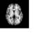 T1 Weighted MRI of brain