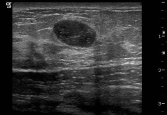 Targeted Breast Ultrasound Can Reduce Biopsies for Women under Forty