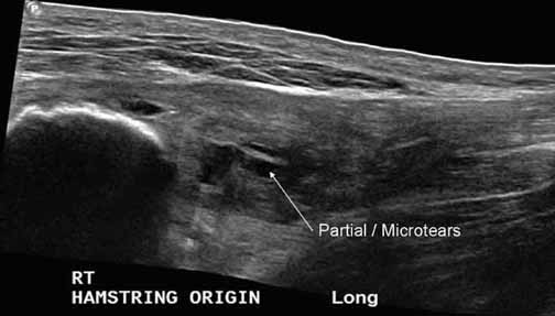 Hamstring Tear Ultrasound