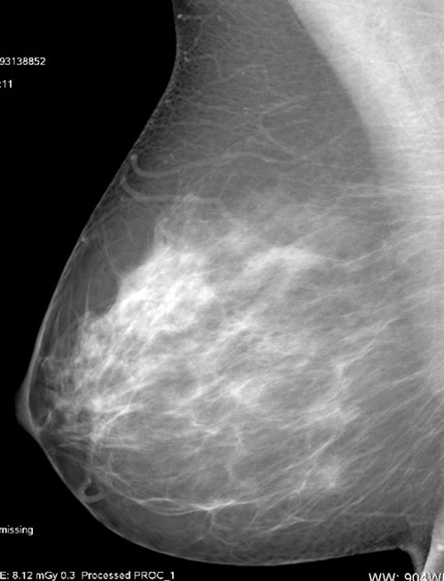 Отечность груди. Фибролипома маммография. Маммография молочных желез. Разрастание тканей молочной железы.