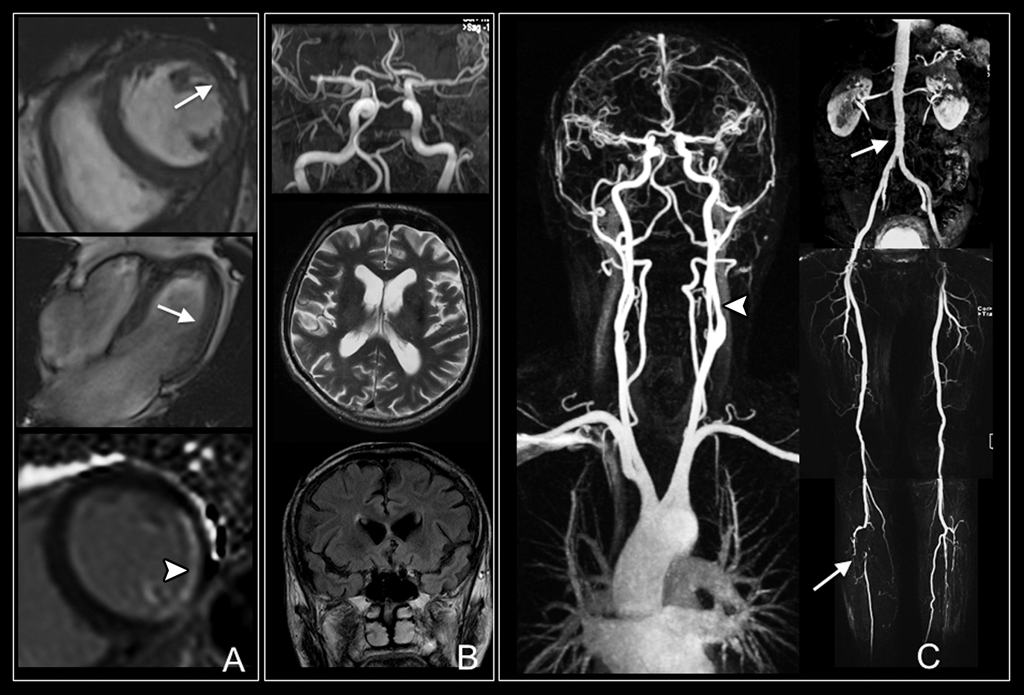Мрт с контрастом головного. Кт (компьютерная томография) сосудов головного мозга. Магнитно-резонансная томография (мрт) сосудов головного мозга. Кт ангиография инсульт. Тромбоз позвоночной артерии мрт.
